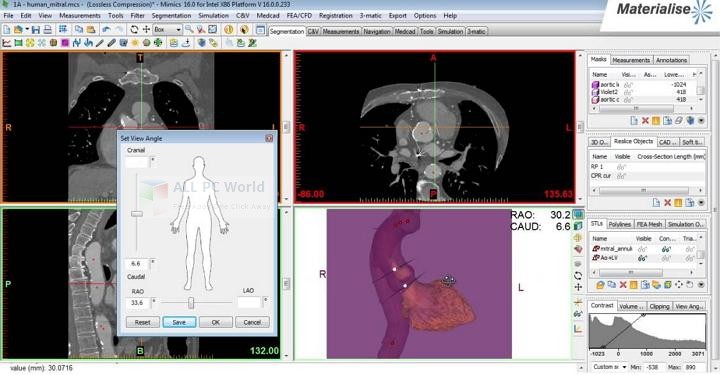 Materialise Mimics Innovation Suite 21